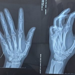 ĐIỀU TRỊ THÀNH CÔNG CA “GÃY XƯƠNG BÀN TAY” CHO BỆNH NHÂN 21 TUỔI