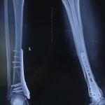 PHẪU THUẬT KẾT HỢP XƯƠNG BẰNG NẸP VÍT CHO NGƯỜI BỆNH “GÃY XƯƠNG CHÀY”