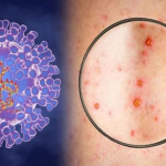 XUẤT HIỆN CA ĐẬU MÙA KHỈ CHƯA XÁC ĐỊNH ĐƯỢC NGUỒN LÂY, CẦN BIẾT 6 KHUYẾN CÁO PHÒNG CHỐNG DỊCH CỦA BỘ Y TẾ