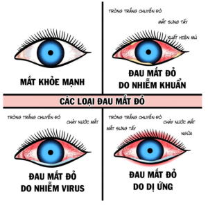BỆNH ĐAU MẮT ĐỎ [VIDEO]