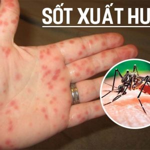 3 XÉT NGHIỆM TÌM CĂN NGUYÊN SỐT XUẤT HUYẾT