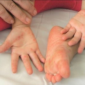 BỆNH TAY CHÂN MIỆNG Ở TRẺ EM (VIDEO)
