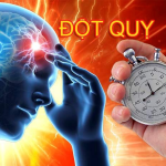 ĐỘT QUỴ XUẤT HUYẾT NÃO CÓ BIỂU HIỆN THẾ NÀO?