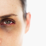 CÁCH GIÚP LOẠI BỎ QUẦNG THÂM MẮT