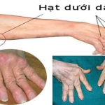 ĐIỀU TRỊ SỚM VIÊM KHỚP DẠNG THẤP ĐỂ TRÁNH TÀN PHẾ