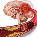 BỆNH TAI BIẾN MẠCH MÁU NÃO (VIDEO)