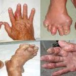 3 MÓN ĂN, THỨC UỐNG CẢI THIỆN BỆNH GOUT