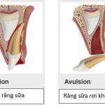CHẤN THƯƠNG RĂNG SỮA