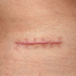 SẸO, NHỮNG ĐIỂM CẦN LƯU Ý