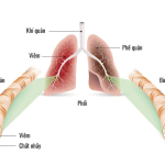 NHỮNG TRIỆU CHỨNG VIÊM PHẾ QUẢN CẤP CẦN LƯU Ý