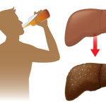 BỆNH GAN NHIỄM MỠ DO RƯỢU LÀ GÌ?