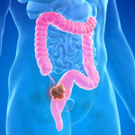 UNG THƯ ĐẠI TRÀNG CÓ PHÒNG NGỪA ĐƯỢC KHÔNG?