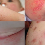 THỜI TIẾT OI NÓNG DỄ BỊ VIÊM DA MỦ, CHỮA THẾ NÀO?