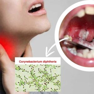 DẤU HIỆU BỊ BỆNH BẠCH HẦU VÀ CÁCH PHÂN BIỆT BỆNH BẠCH HẦU VỚI VIÊM HỌNG
