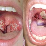 BỆNH BẠCH HẦU LÂY NHƯ THẾ NÀO?