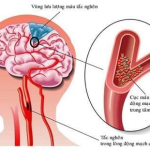 ĐỘT QUỴ: NGUYÊN NHÂN, DẤU HIỆU NHẬN BIẾT, CÁCH PHÒNG TRÁNH