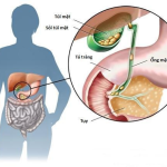 SỎI MẬT KHI NÀO CẦN PHẢI MỔ?