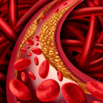 NGƯỜI BỆNH HẸP ĐỘNG MẠCH THẬN CẦN LƯU Ý GÌ TRONG TẬP LUYỆN?