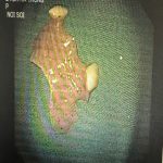 BVĐK HÀ TRUNG: NỘI SOI CAN THIỆP GẮP “DỊ VẬT LỚN” ĐƯỜNG TIÊU HOÁ