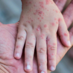 BỆNH SỞI LÀ GÌ? DẤU HIỆU NHẬN BIẾT VÀ CÁCH PHÒNG NGỪA