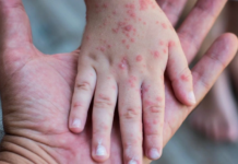 BỆNH SỞI LÀ GÌ? DẤU HIỆU NHẬN BIẾT VÀ CÁCH PHÒNG NGỪA